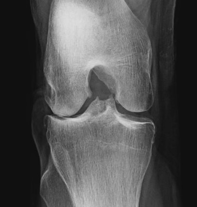 Knee OA Rosen View